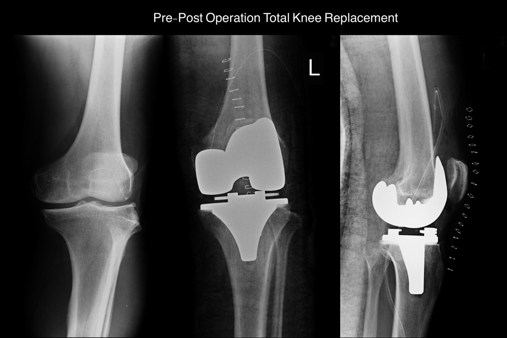 Xray,Left,Knee,And,Show,Pre-post,Operation,Total,Knee,Replacement